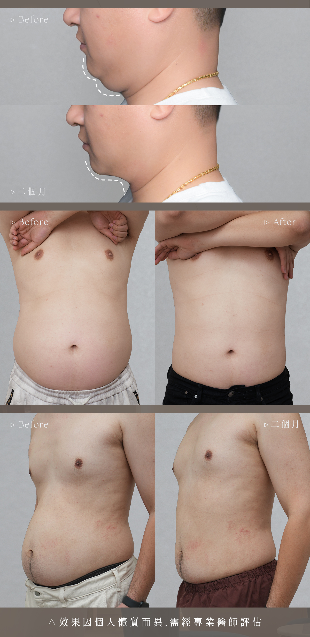 美力時尚診所冷凍減脂：女生局部脂肪改善案例