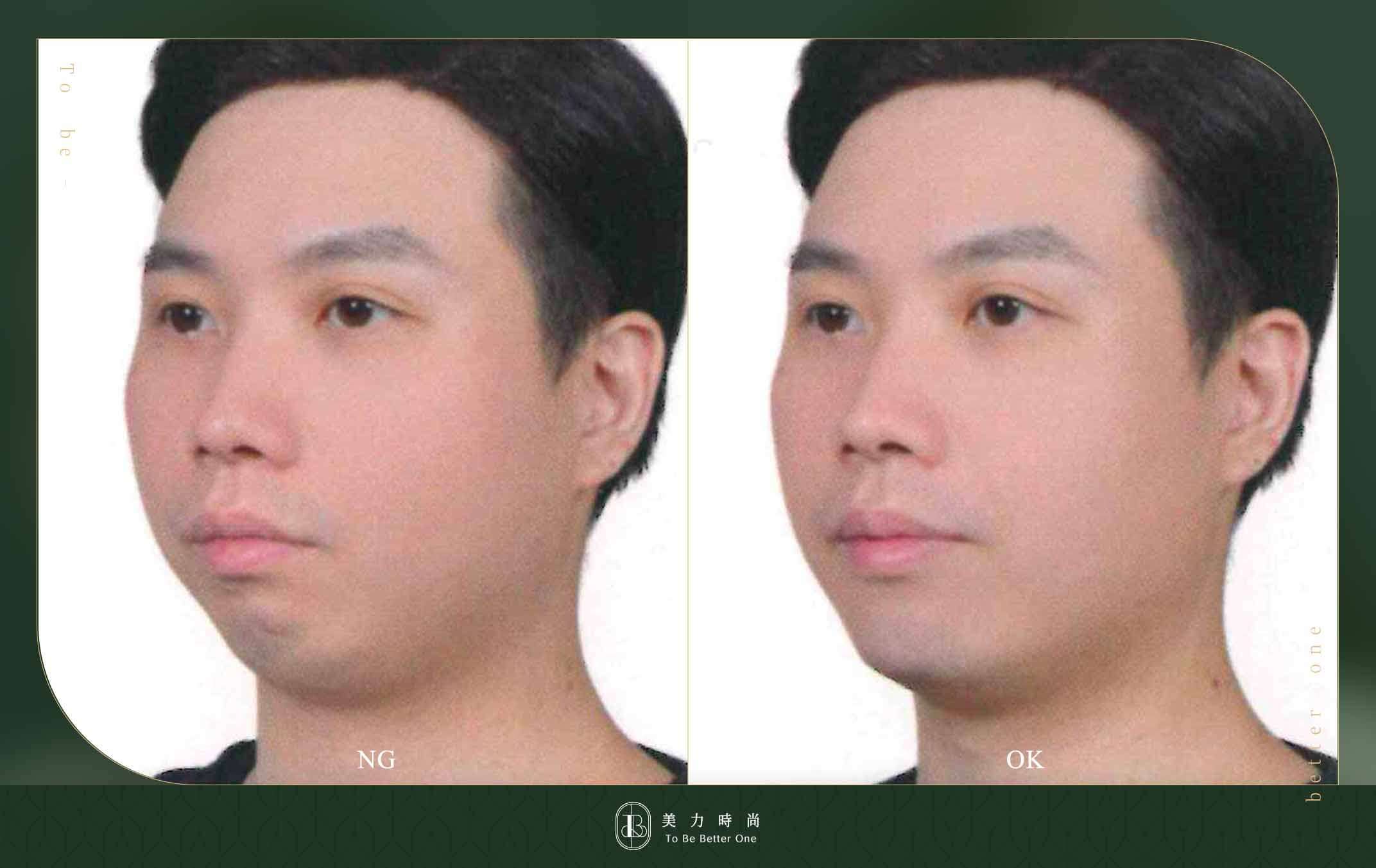 原廠提供之喬雅登玻尿酸療程後改善圖