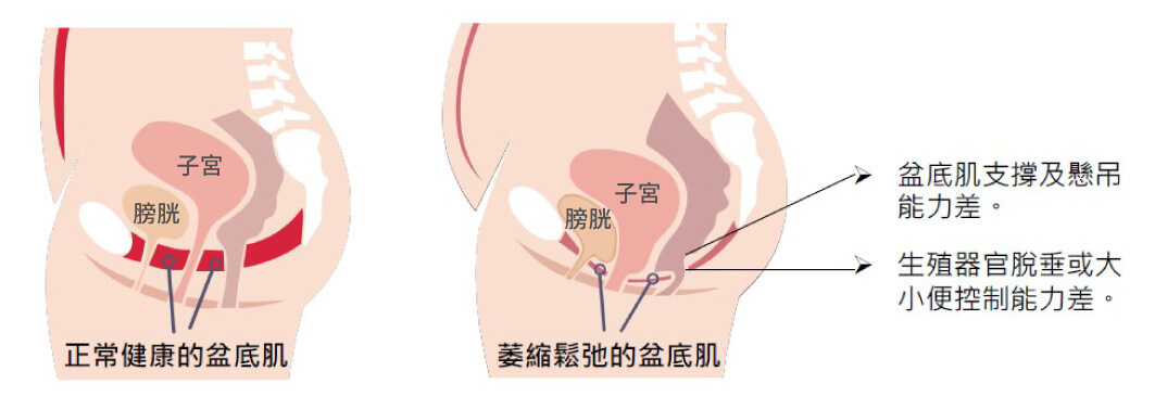 正常健康盆底肌與萎縮鬆弛盆底肌比較示意圖