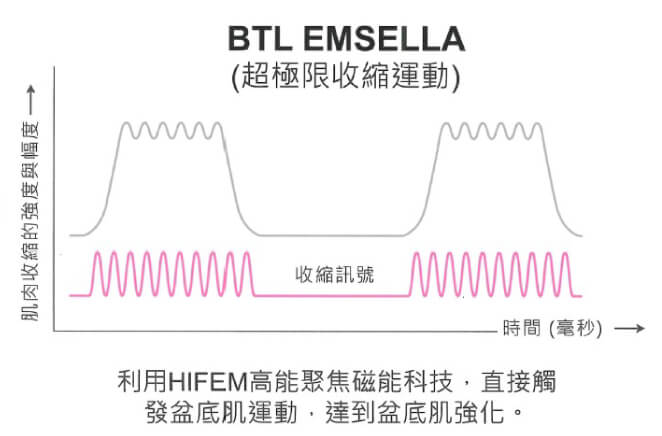 EMSELLA G動椅與凱格爾運動肌肉收縮的強度與幅度比較「G動椅透過科技觸發盆底肌運動，達到強化｣