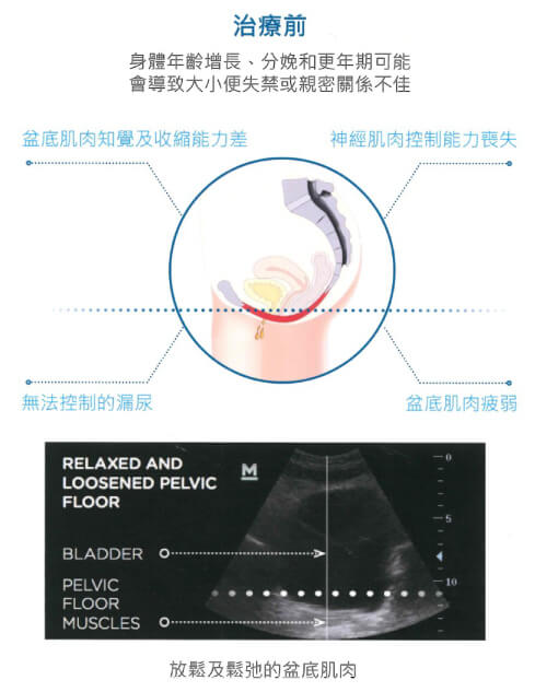 治療前與治療後比較圖-治療前