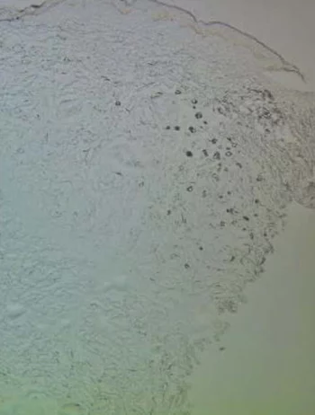 粒子在真皮層的作用圖