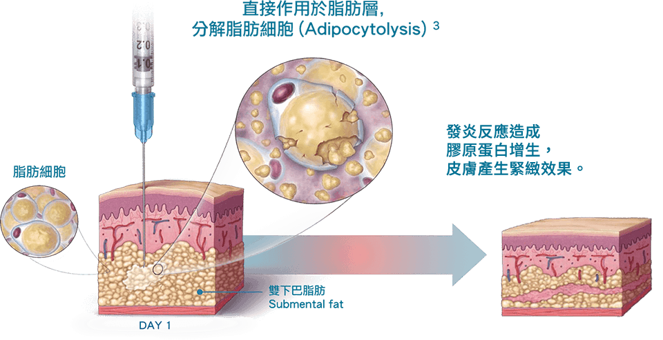 Belkyra倍克脂 機轉原理說明圖