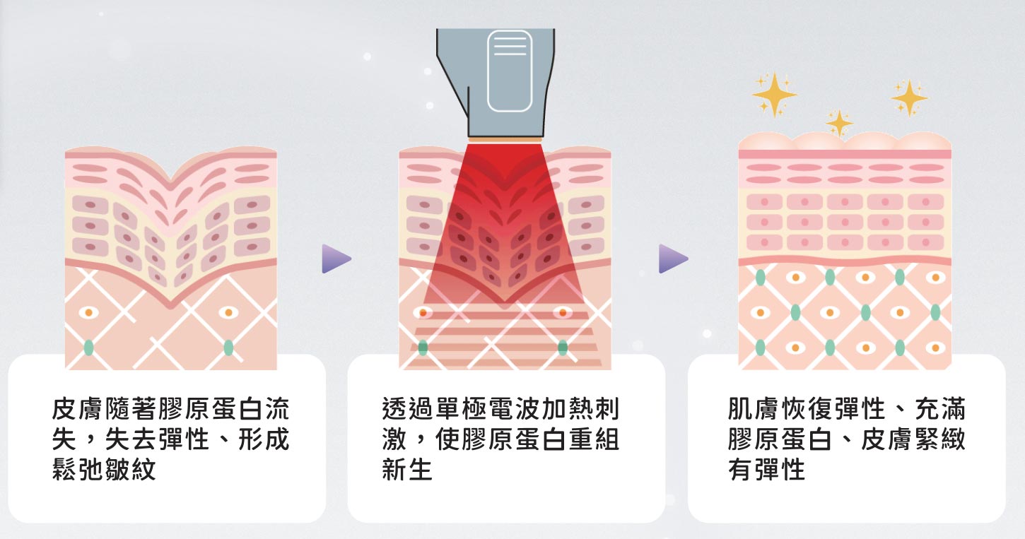 單極電波原理說明圖