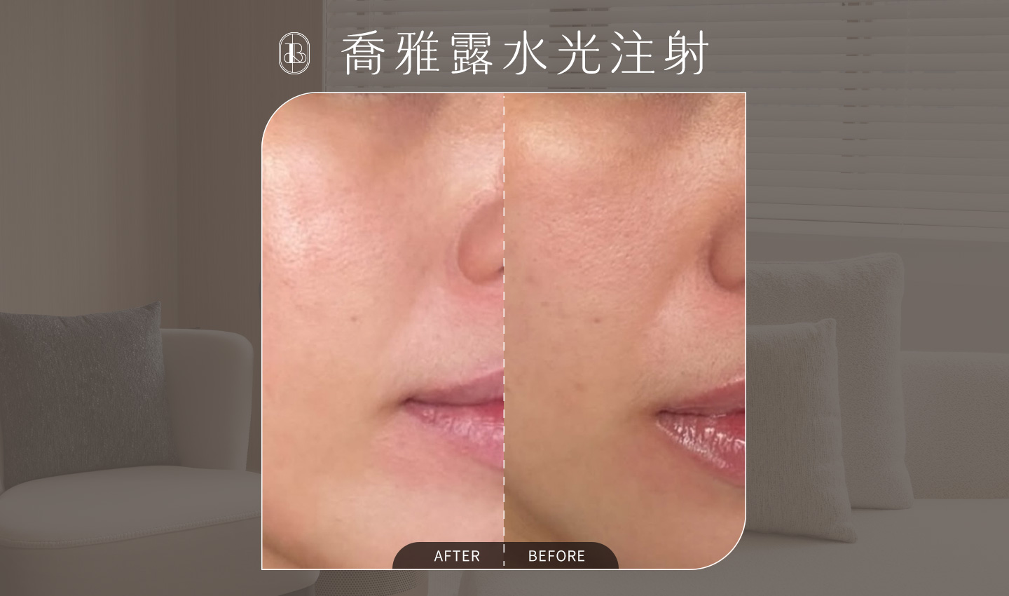 喬雅露水光針-AKA-BA