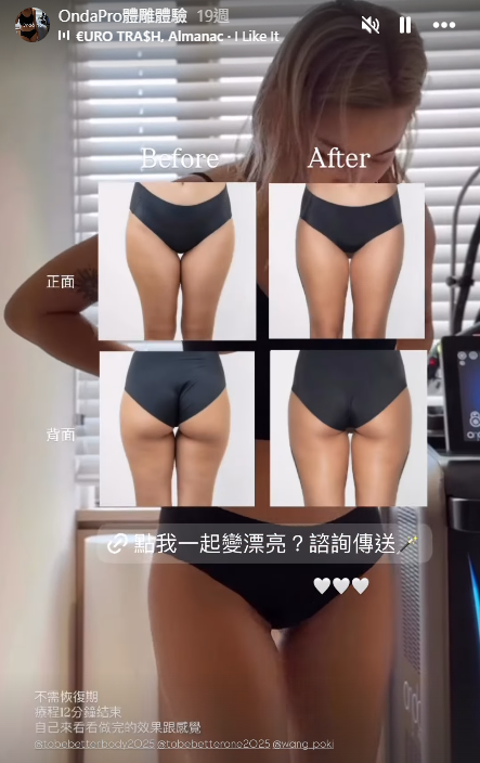 大腿線條雕塑BA