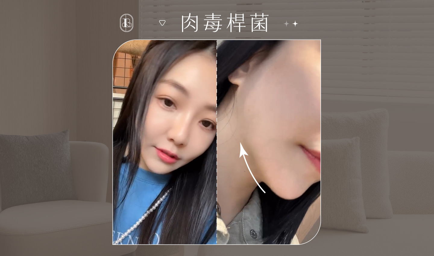 網紅《小日刀口》奇蹟肉毒除皺+咀嚼肌體驗心得分享