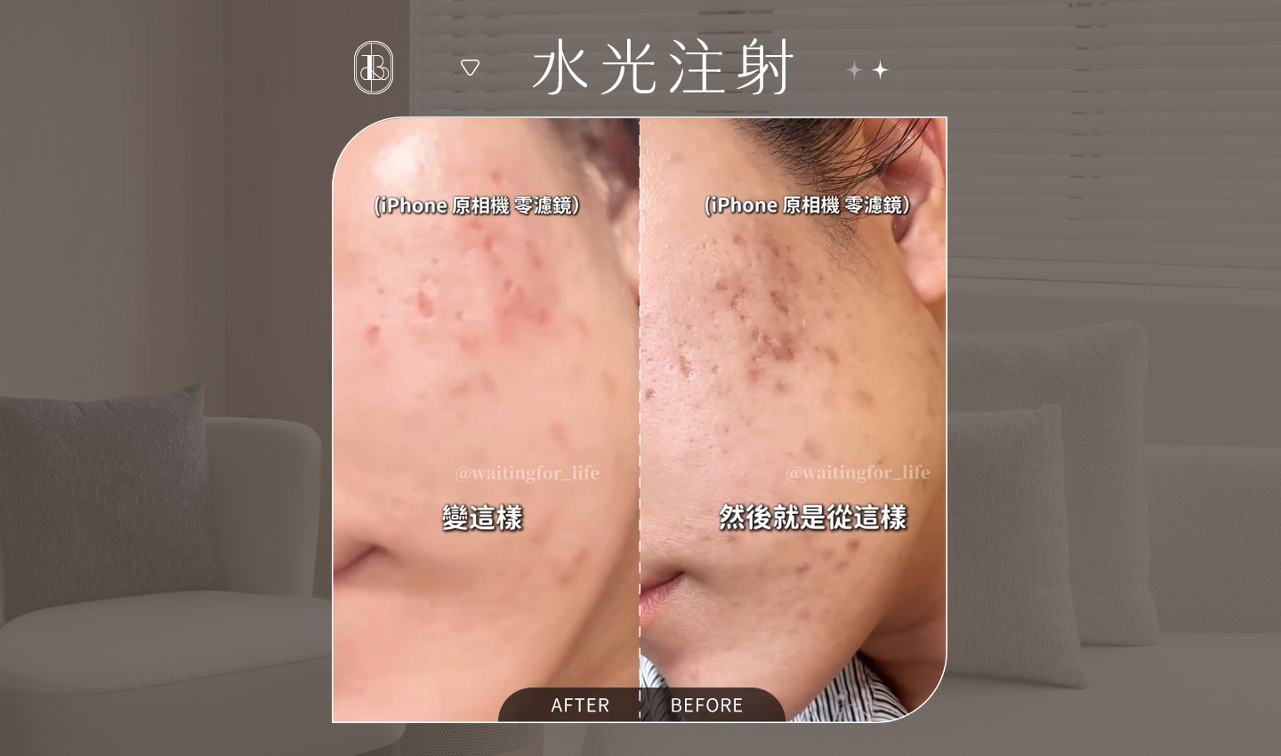 網紅《等等》水光針體驗心得分享