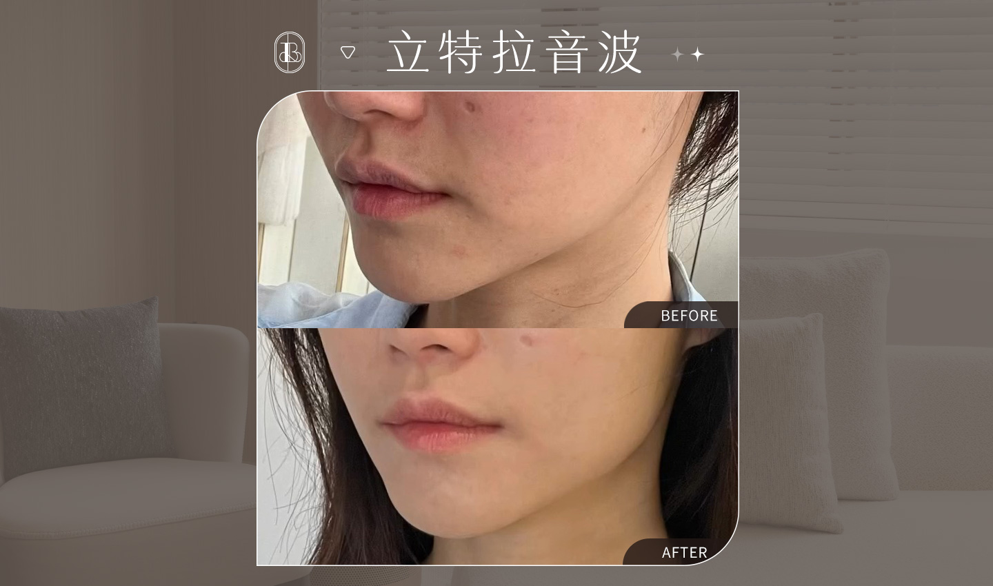 網紅《Uni》立特拉音波體驗心得分享