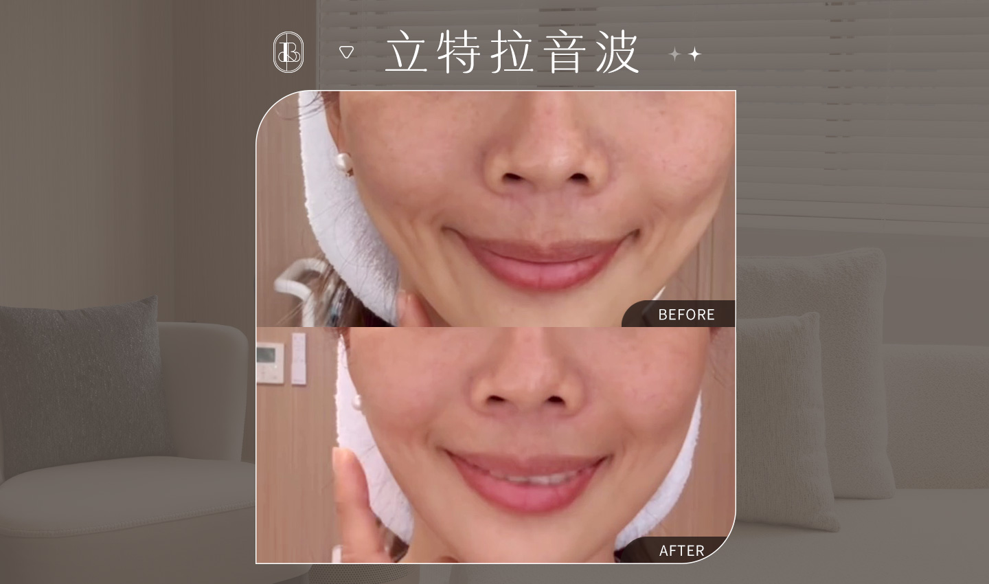 網紅《沙莫太太 Summer》立特拉音波~嘴邊肉的逆襲體驗心得分享