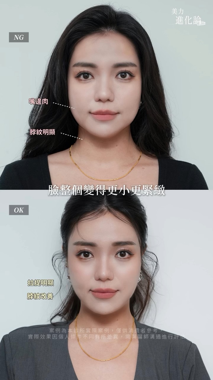 海芙電音雙波施作後後對比~拉提明顯