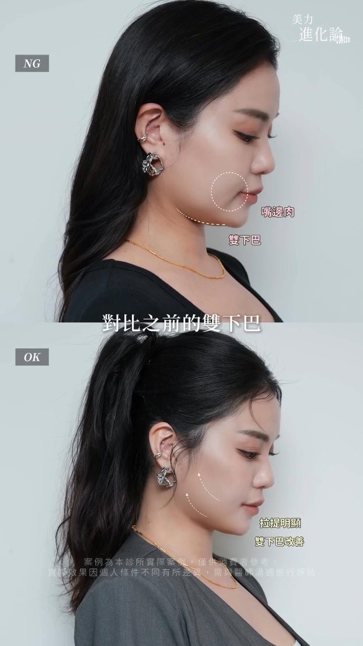 海芙電音雙波施作前後對比~改善嘴邊肉、雙下巴