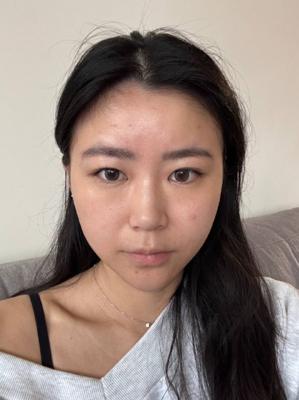 療程前正臉-鬆弛、輪廓線模糊、法令紋明顯