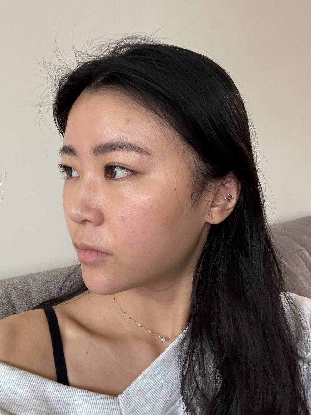 療程前側臉-鬆弛、輪廓線模糊