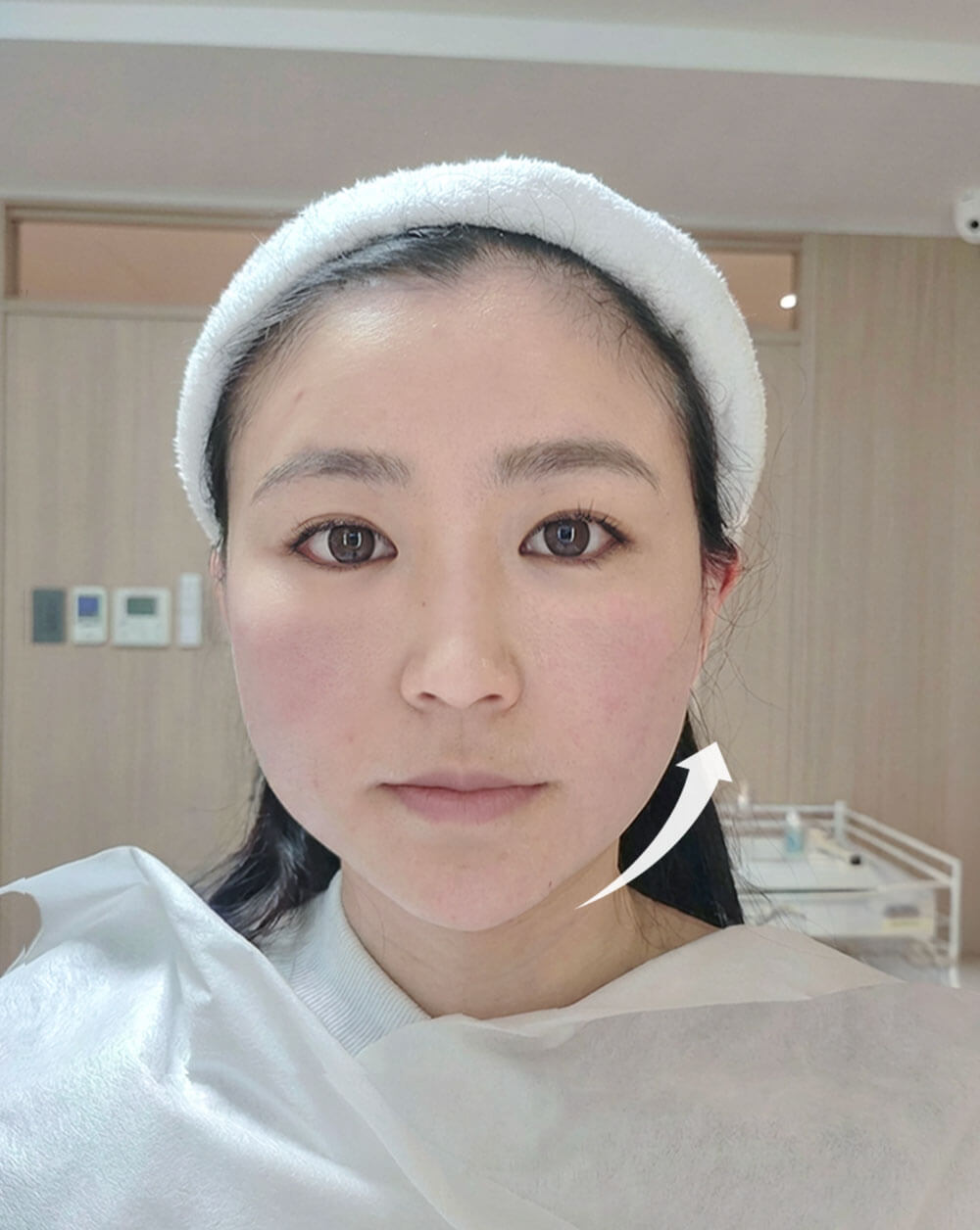 Dcard樂蓁-海芙電音雙波010-術後當下半臉施打對比照