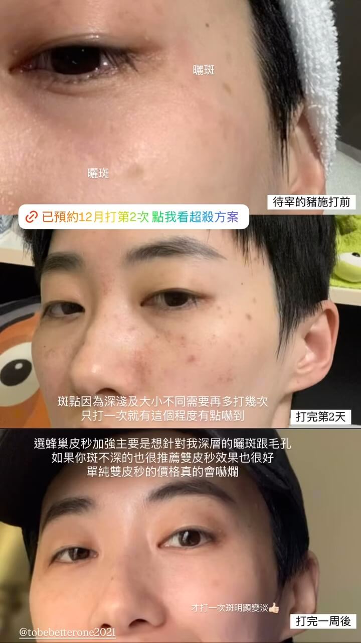 KOL-江 Jiang蜂巢皮秒BA