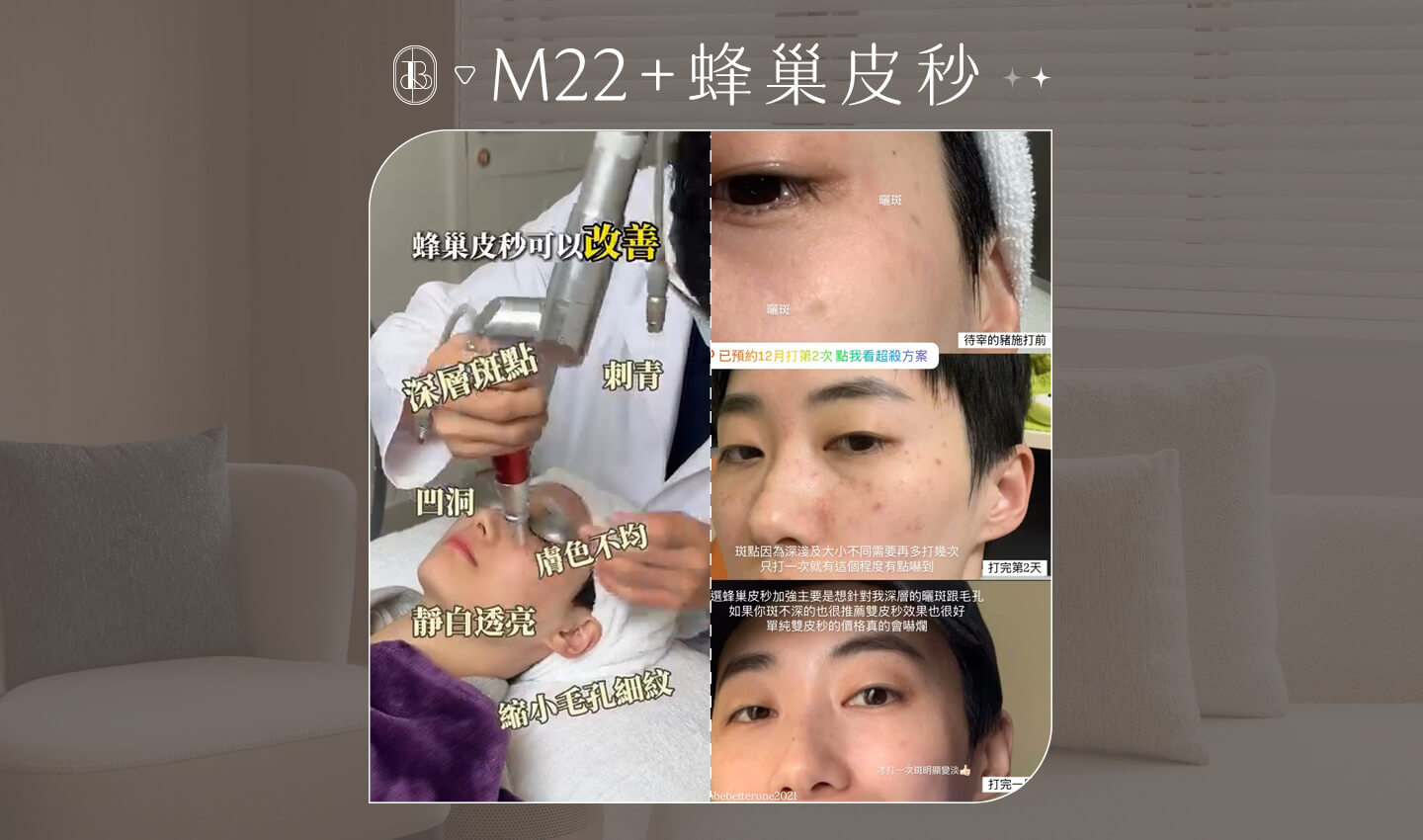 KOL-江 Jiang M22脈衝光+蜂巢皮秒BA+施打圖