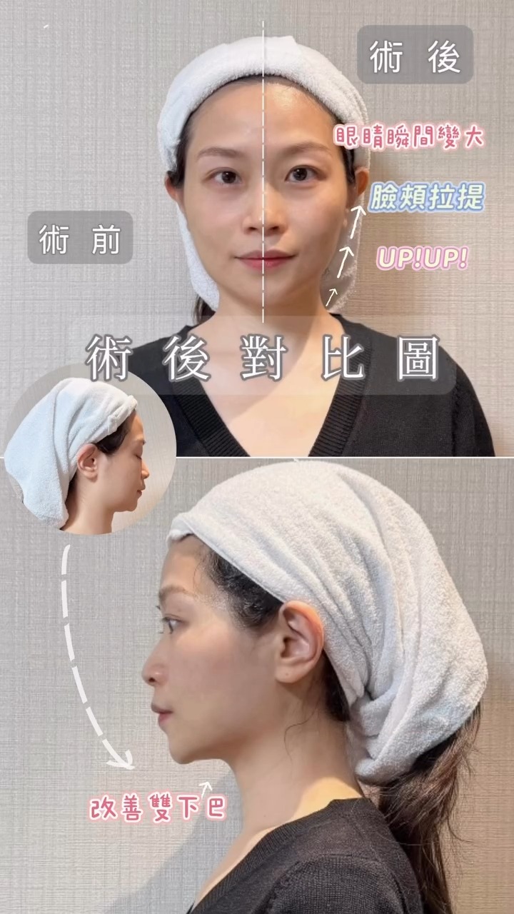 十蓓電波-術前術後變化