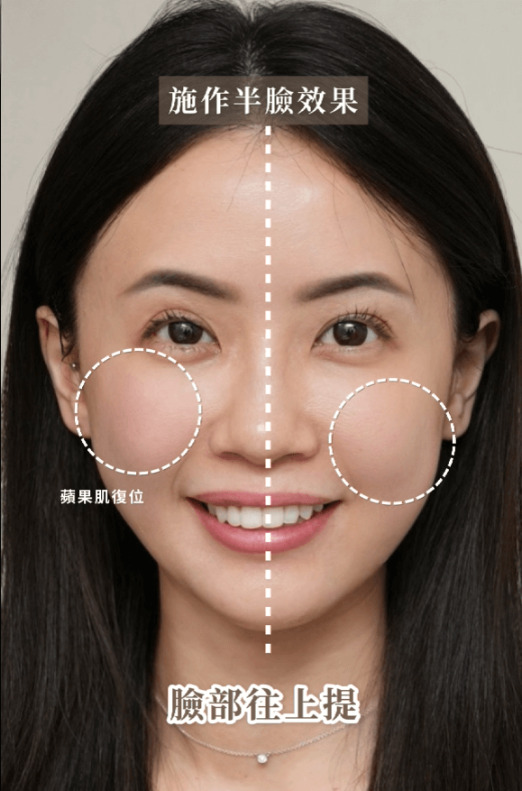 十蓓電波BA施作當下