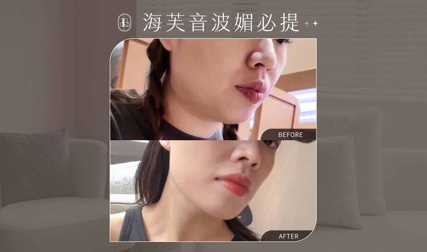 美力時尚診所案例，網紅《莉芙太樂》海芙媚必提術前術後效果，改善雙下巴，下顎線明顯收緊