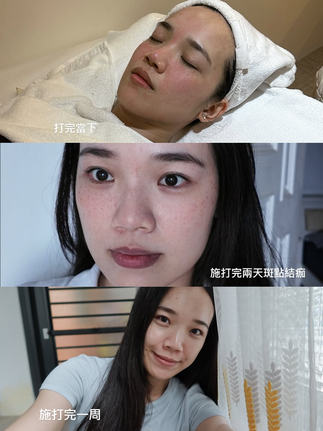 KOL KIKI施作皮秒蜂巢後的皮膚變化