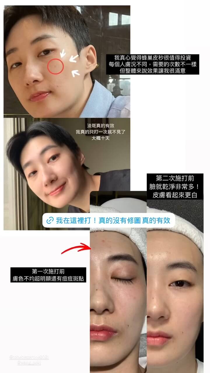 KOL-江 Jiang-M22脈衝光+蜂巢皮秒BA