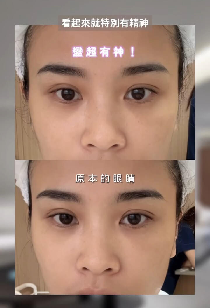 立特拉音波-安妮-眼周BA-1