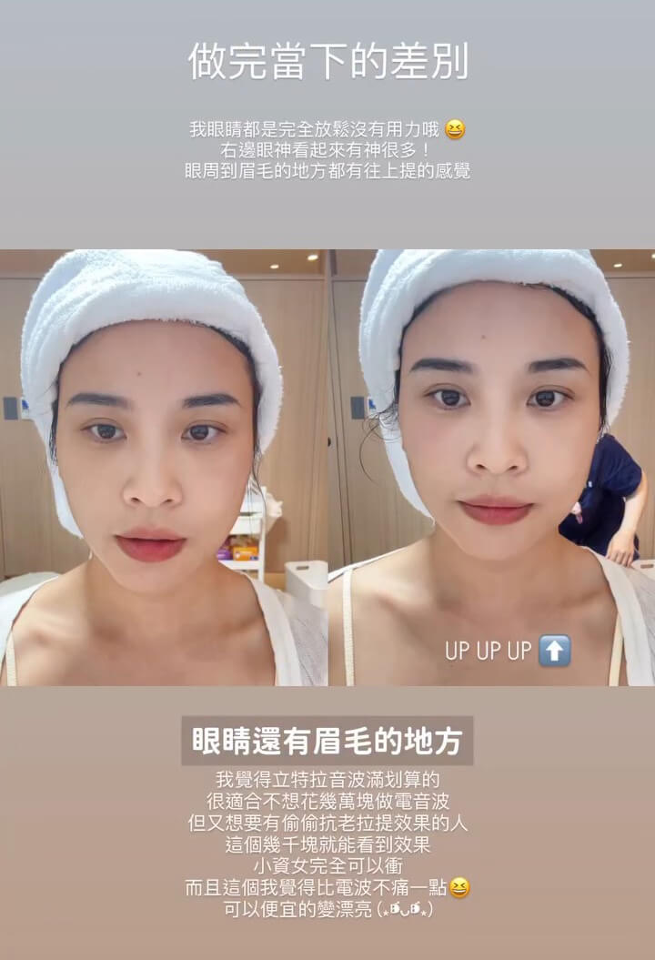 立特拉音波-安妮-眼周BA-1