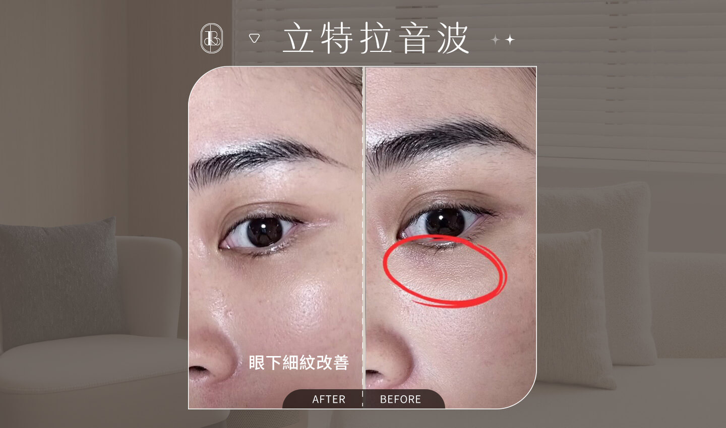 立特拉音波-安妮 眼周ba