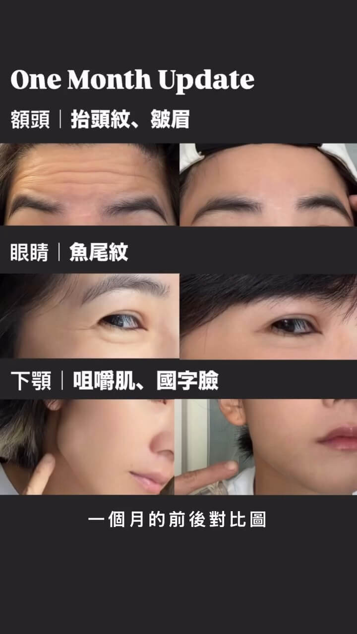 KOL睡睡子施打肉毒-抬頭紋+魚尾紋+咀嚼肌BA(額頭12U+眼尾各10+咀嚼肌各25U)
