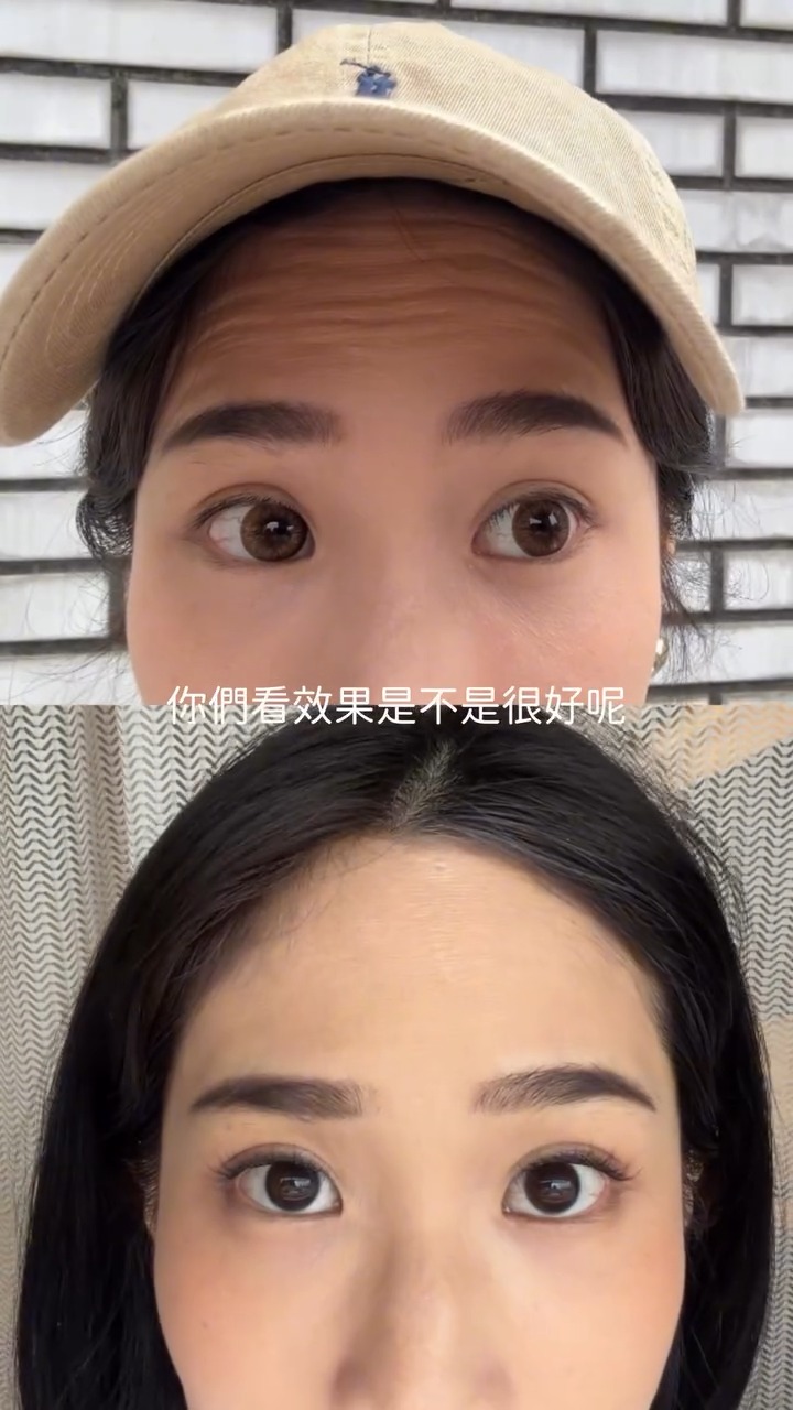 改善抬頭紋-肉毒除皺