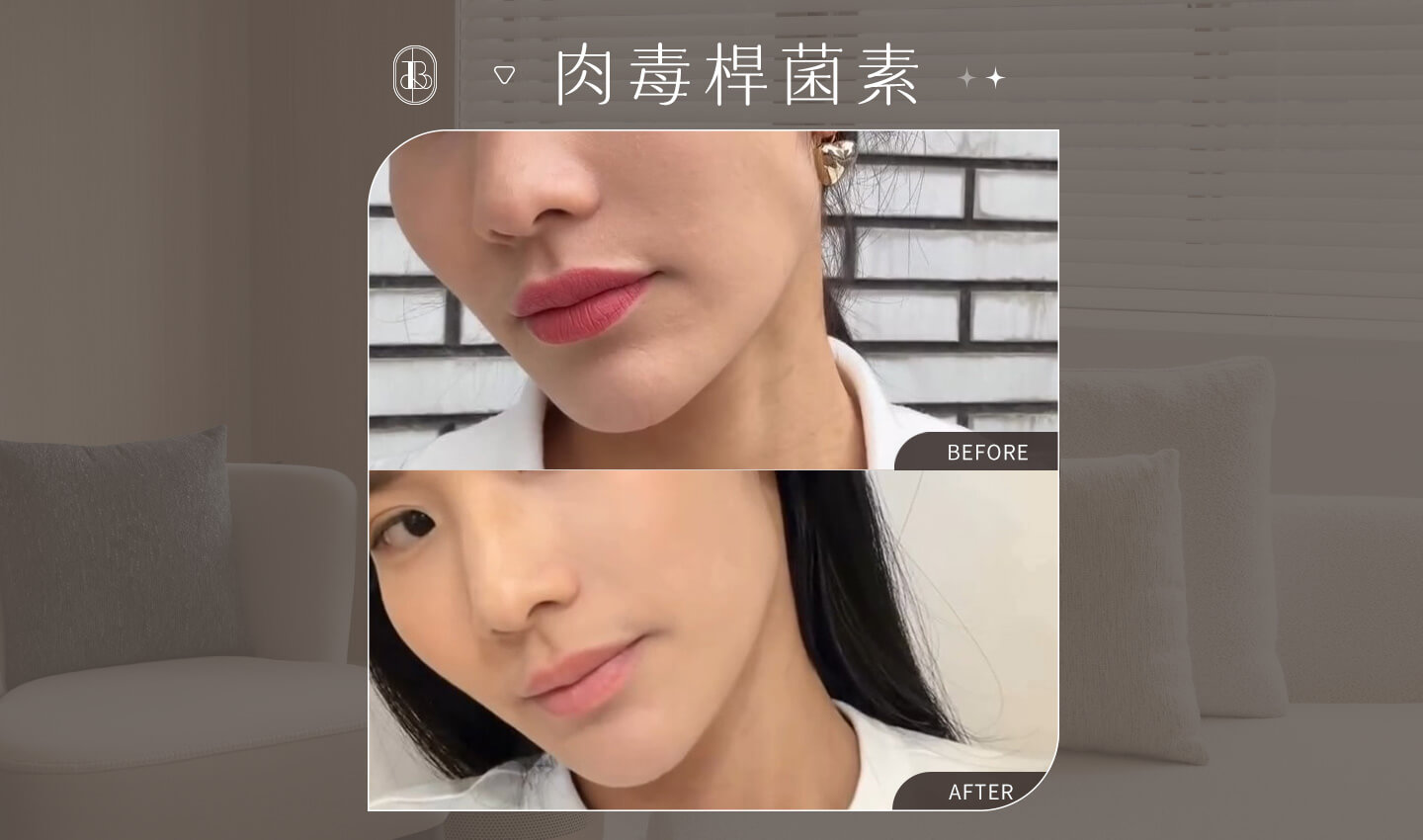 肉毒除皺+咀嚼肌-陶薇薇-cover