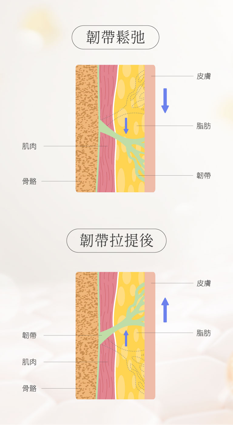 臉部韌帶鬆弛與拉提對比