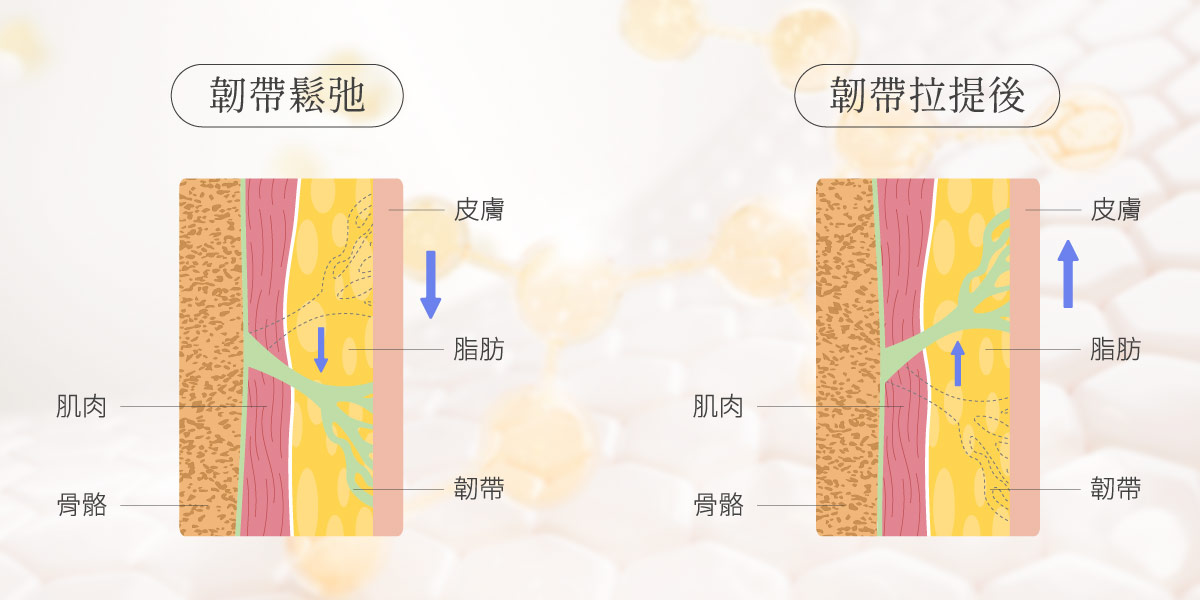 臉部韌帶鬆弛與拉提對比