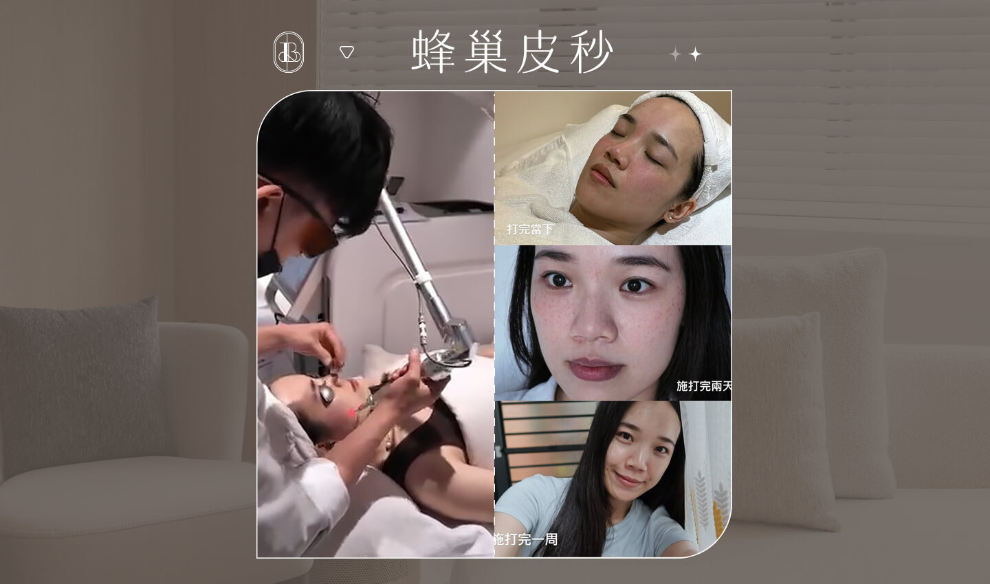 蜂巢皮秒體驗-KiKi