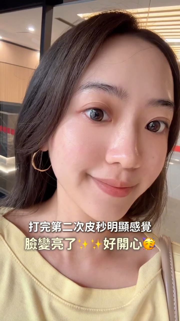 Olivia施打蜂巢皮秒兩天後感覺臉變亮了