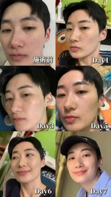 M22脈衝光+蜂巢皮秒術前+術後7天膚況記錄