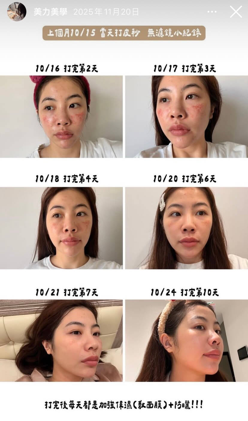 網紅 臆庭 施打皮秒後追蹤紀錄