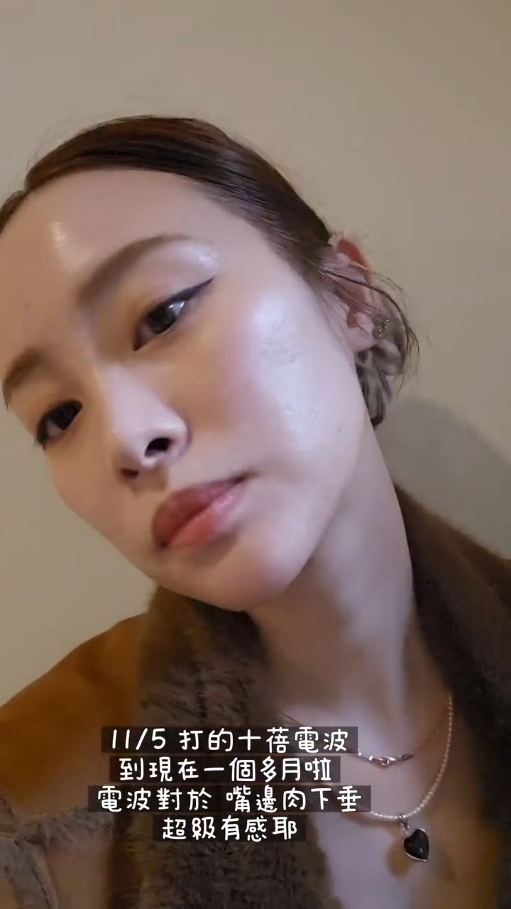 陳彤彤施打十蓓電波，改善嘴邊肉