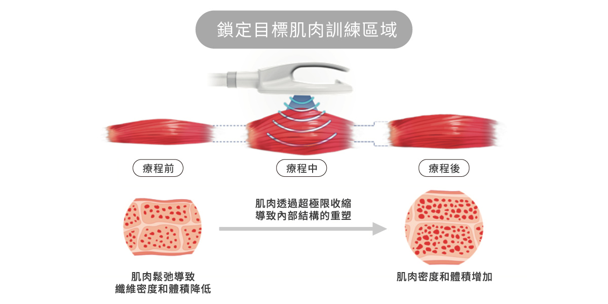 260202_醫美新知_衛教文-非侵入式體雕指南_肌肉訓練