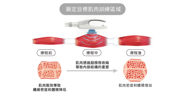 260202_醫美新知_衛教文-非侵入式體雕指南_肌肉訓練_手機
