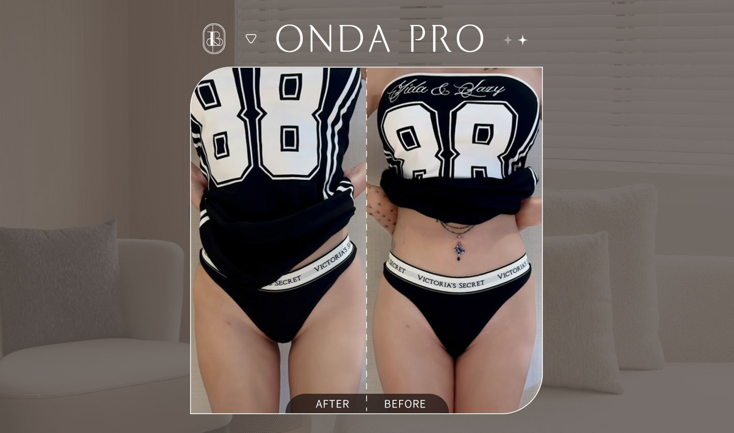 網紅《柔E老師》ONDA PRO超微波體驗心得分享~非侵入式體雕-大腿線條雕塑