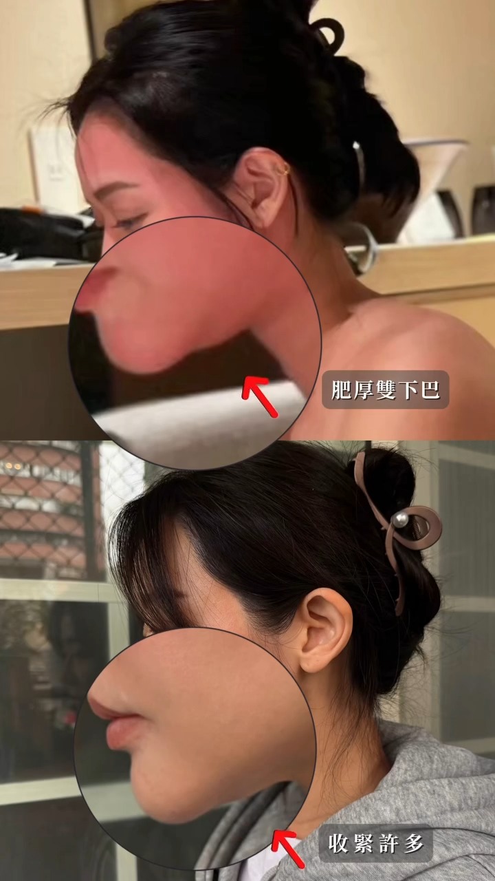 十蓓電波-潘森森BA 雙下巴變化