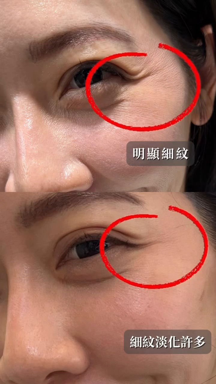 十蓓電波-潘森森 眼周改善