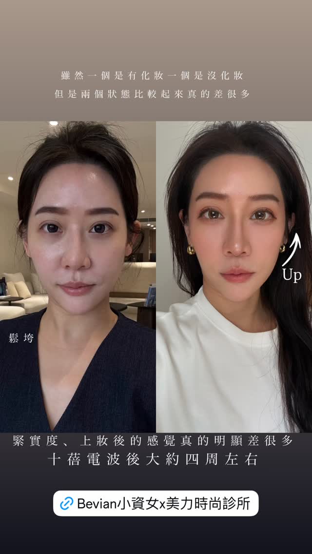 KOL潘森森 十蓓電波施打完四周後的整體臉部狀態變化
