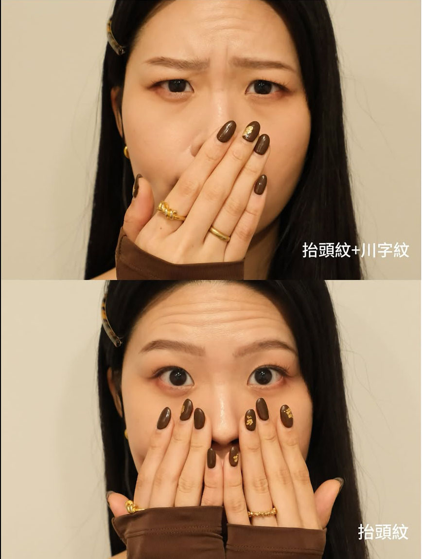 KOL Yan Chen 抬頭紋、川字紋