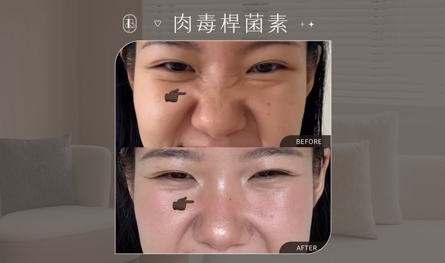 肉毒除皺BA-Angela