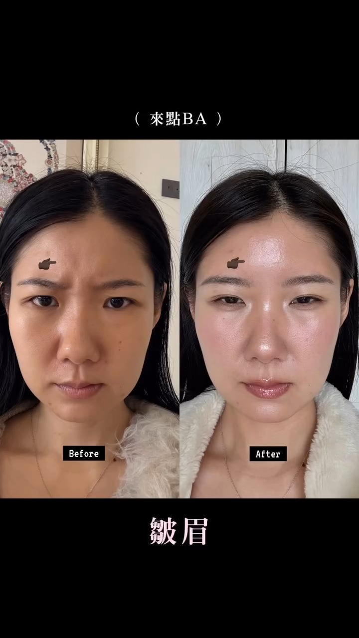 肉毒除皺-Angela-皺眉紋BA