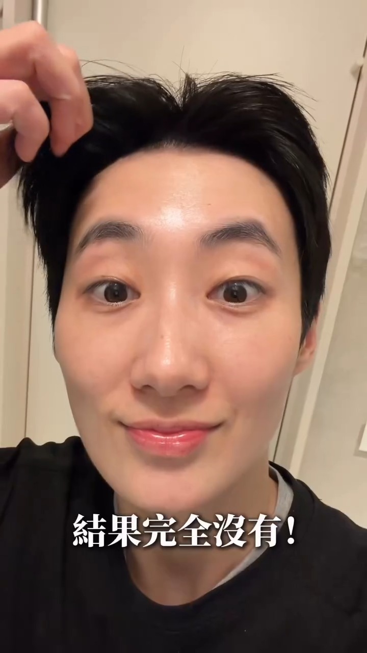 肉毒抬頭紋術後