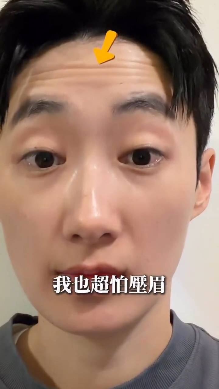 肉毒抬頭紋術前